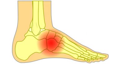Midfoot Sprain – Zao Rehab