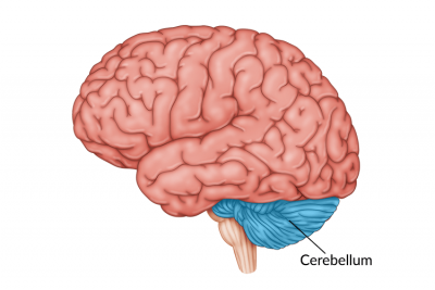 cerebellar-stroke-and-stroke-in-the-cerebellum