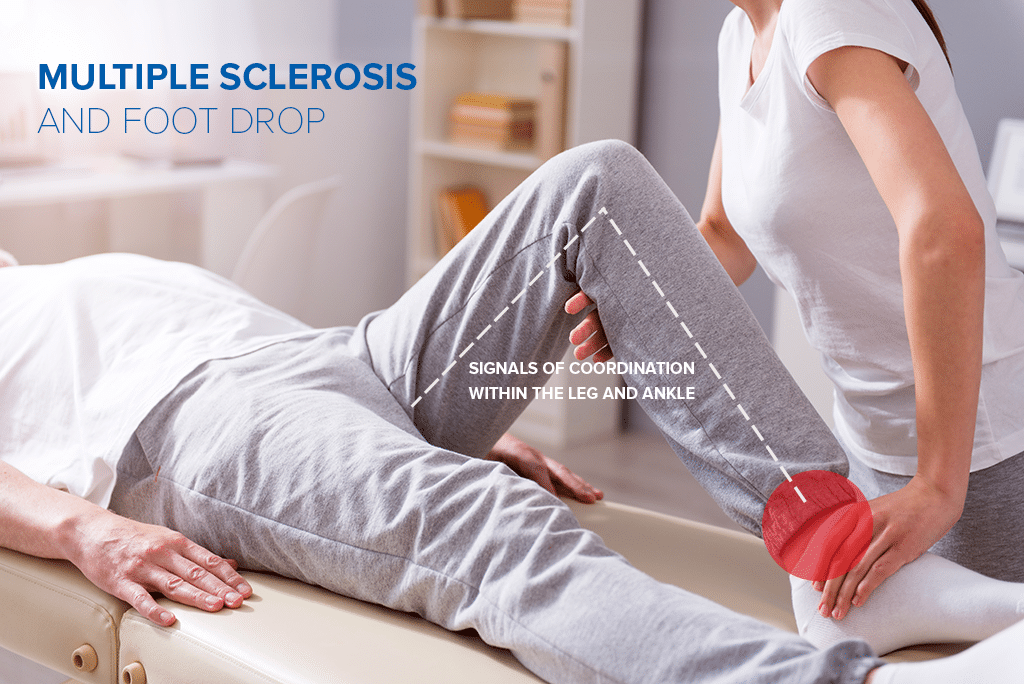 ms-footdrop-1024x684