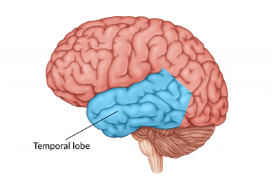 temporal-lobe-damage